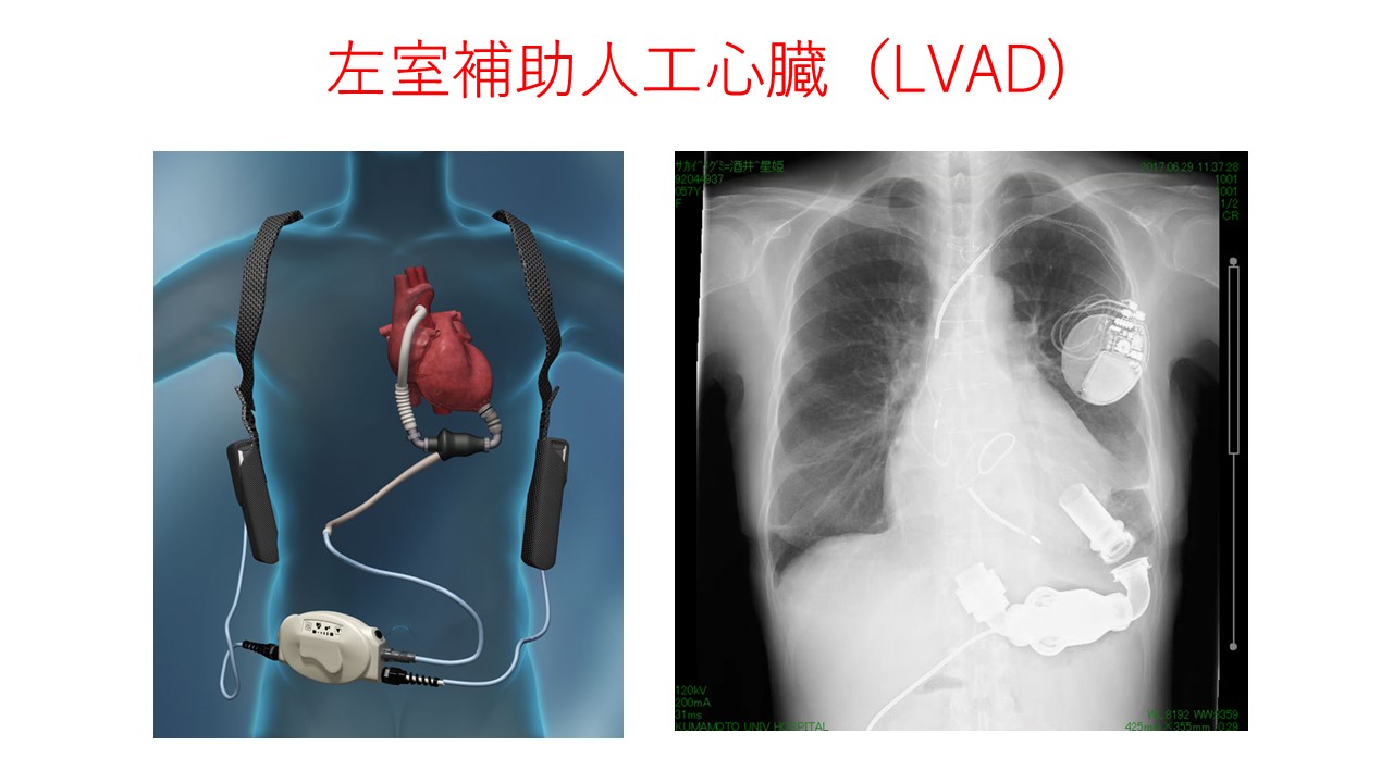 熊本大学病院 循環器内科 心不全に対する最新の治療